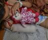 UN: Every day, 10 Gaza children lose one or both legs due to Israel's war