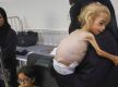 Gaza kids suffer from extreme malnutrition