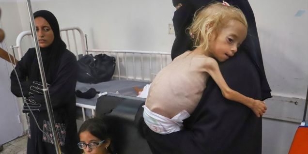 Gaza kids suffer from extreme malnutrition